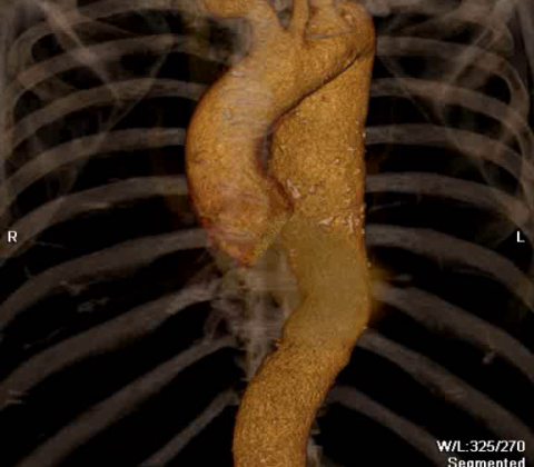 Advanced TEVAR for Descending Thoracic Aortic Aneurysm