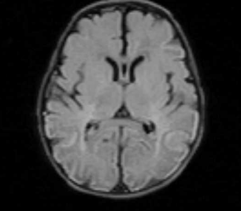 Neonatal Hypoglycaemic Encephalopathy