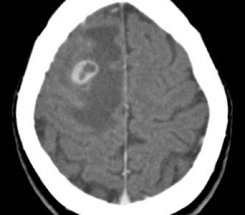 Parenchymal Neurocysticercosis