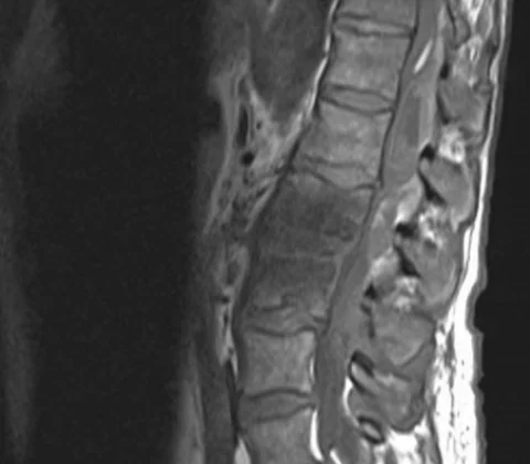 Spontaneous spinal epidural haematoma