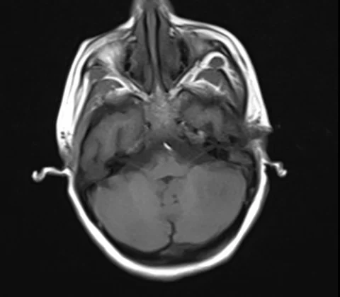 Intracranial tuberculous granuloma (tuberculoma)
