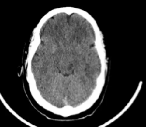 Acute disseminated encephalomyelitis (ADEM)