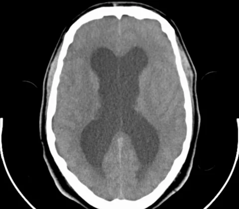 Colloid cyst of the third ventricle