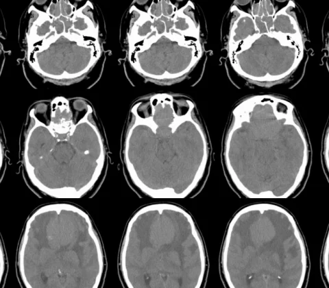 Olfactory groove meningioma