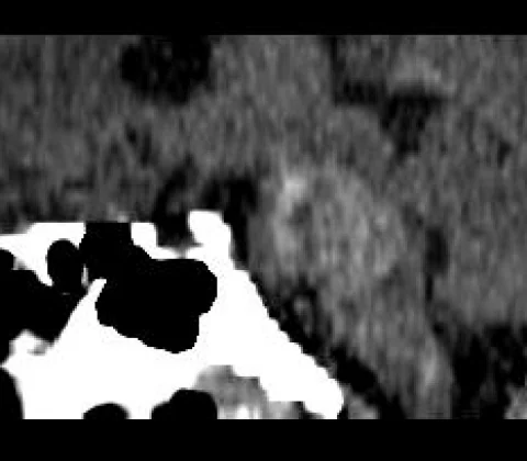 Giant pontine cavernoma