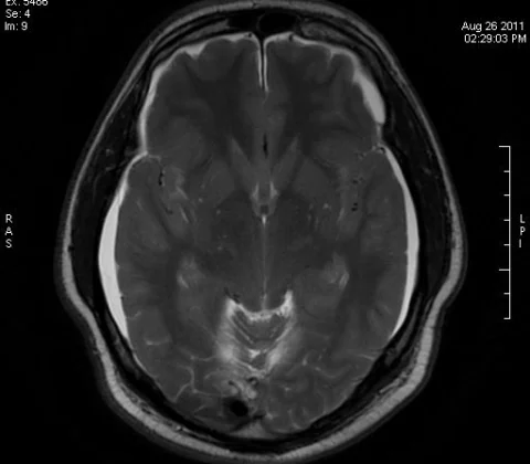 Spontaneous intracranial hypotension