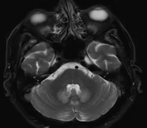 Metronidazole-induced encephalopathy