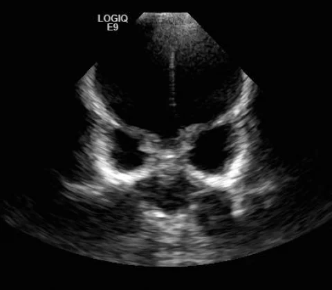 Hydrocephalus