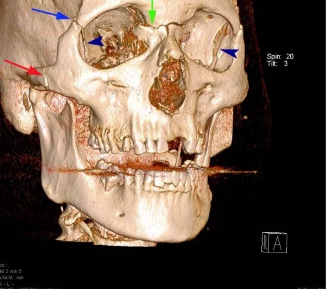 Le Fort III fracture (craniofacial disjunction)
