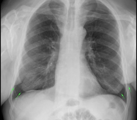 Madelung disease type I