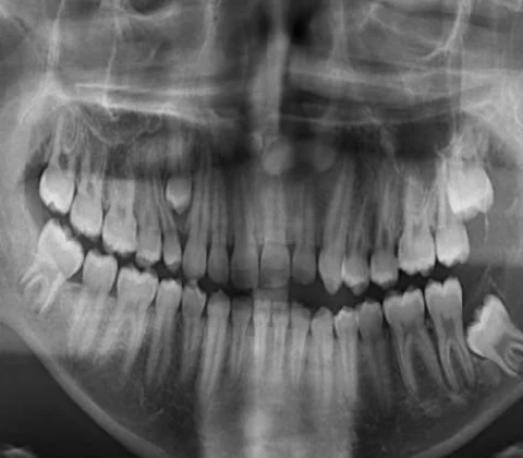 Desmoplastic fibroma of the mandible