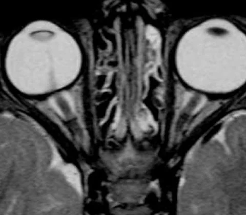 Persistent hyperplastic primary vitreous