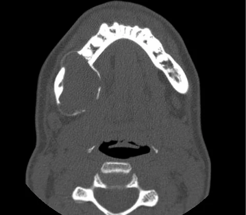Recurrent ameloblastoma of the right jaw after conservative surgery
