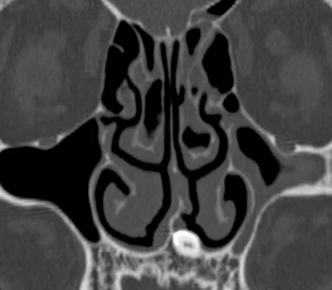 Ectopic nasal tooth