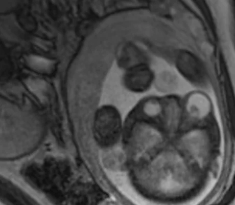 Congenital orbital teratoma