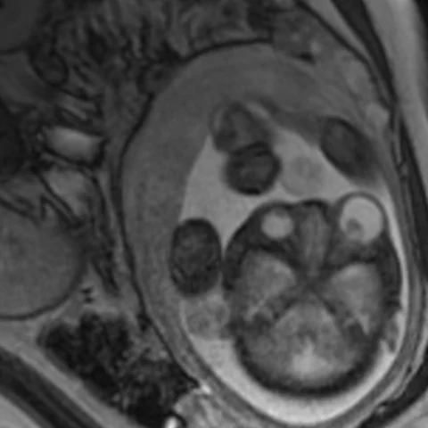 Congenital orbital teratoma