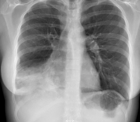 Endobronchial carcinoid