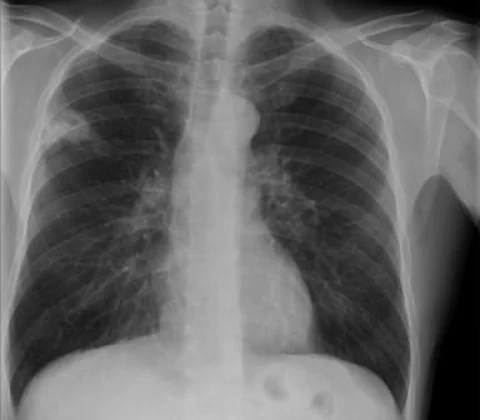 Pulmonary nocardiosis in HIV