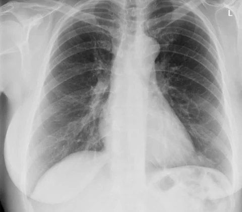 Chronic eosinophilic pneumonia