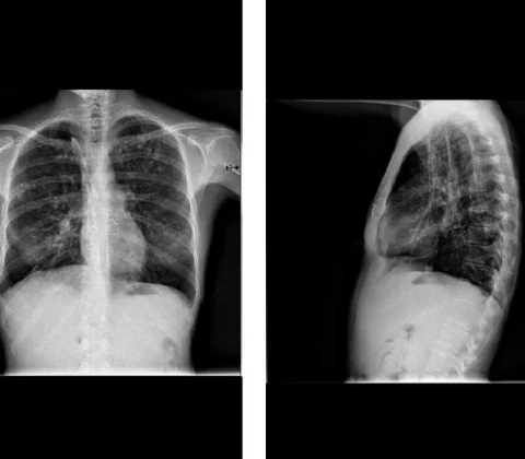 Metastatic pulmonary calcification secondary to haemodialysis