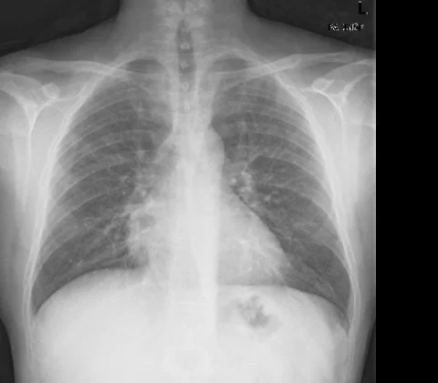 Pulmonary fibrosis due to paraquat poisoning