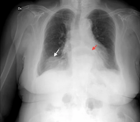 Bochdalek hernia