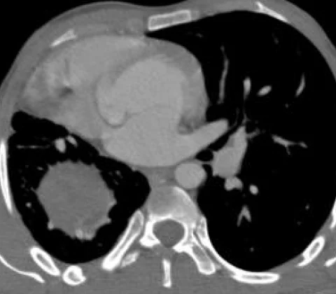 Scimitar syndrome with horseshoe kidney and portal vein thrombosis
