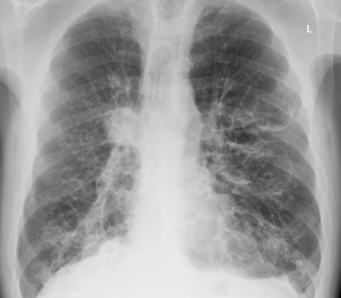 Mounier-Kuhn syndrome (tracheobronchomegaly)