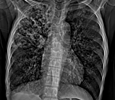 Pulmonary tuberculosis