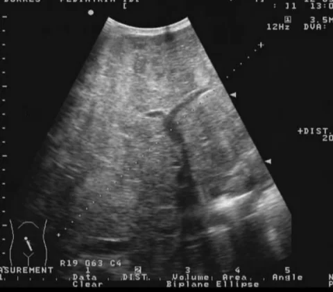 Macronodular liver cirrhosis with ascites