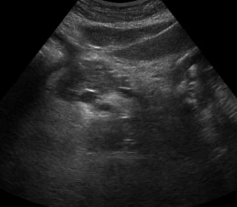 Pancreatic lipoma