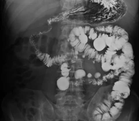Small bowel diverticulosis