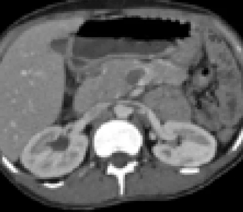 Torsion of a wandering spleen