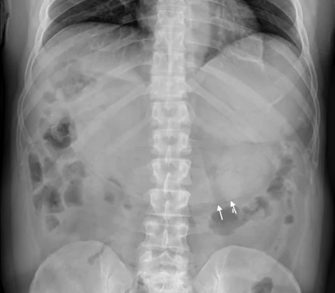 Gastric pneumatosis due to gastric outlet obstruction