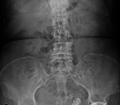 Spigelian hernia