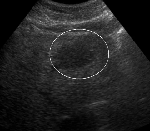Primary hepatic follicular lymphoma