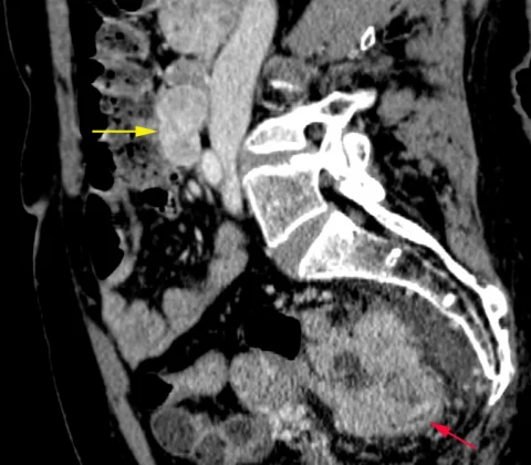 Synchronous duodenal GIST and colorectal adenocarcinoma