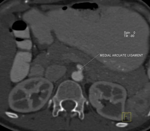Coeliac artery compression by the median arcuate ligament