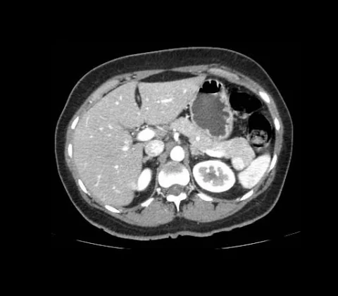 Accessory spleen confirmed on histology