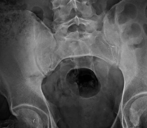 Infective sacroiliitis complicated by a pelvic muscle abscess