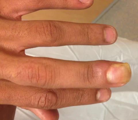 Subungual epidermoid cyst