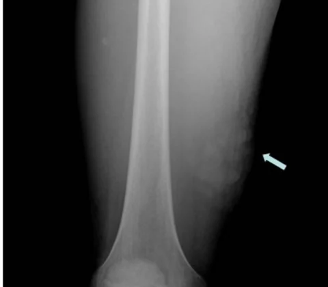 Kaposi sarcoma with skin and muscle involvement