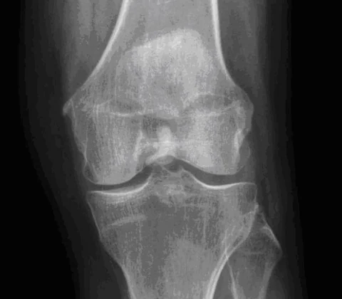 Hydroxyapatite deposition disease (HADD), intra-articular