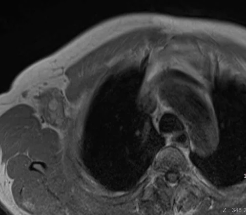 Fasciitis with ischaemic features