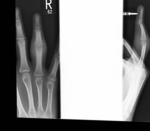 Intra-articular osteoid osteoma of the proximal phalanx