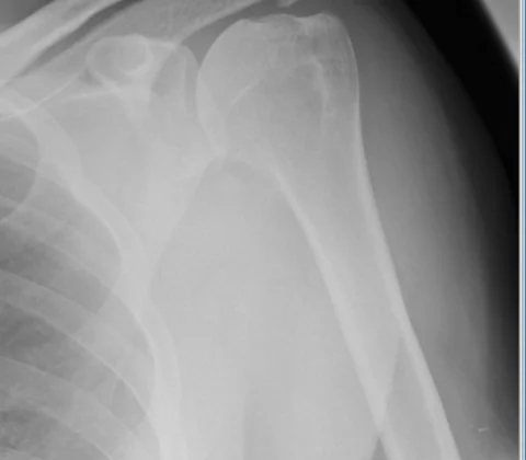 Primary synovial chondromatosis
