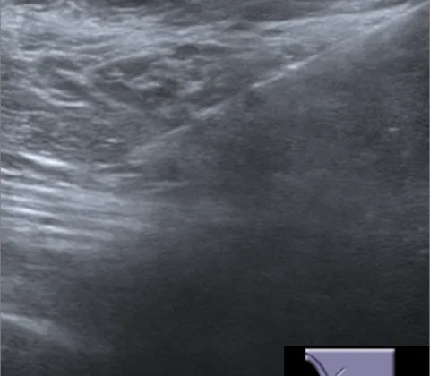 Adenomyoepithelioma
