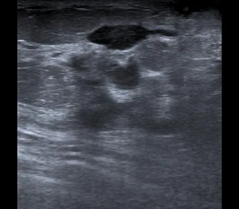 Idiopathic granulomatous mastitis