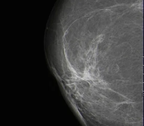 Microcystic calcifications of fat necrosis