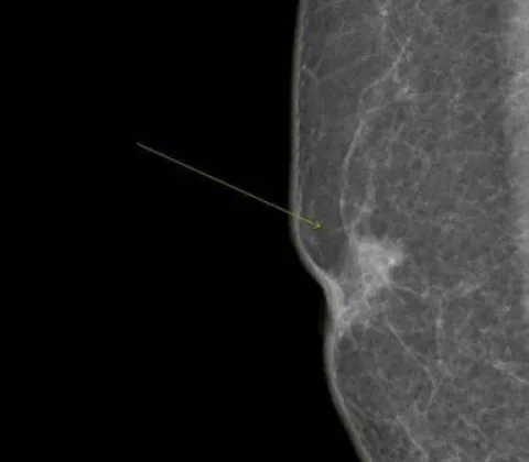 Male breast cancer, synchronous tumours, bilateral